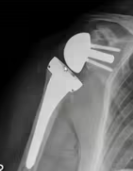 La radiografia di una protesi di spalla inversa
